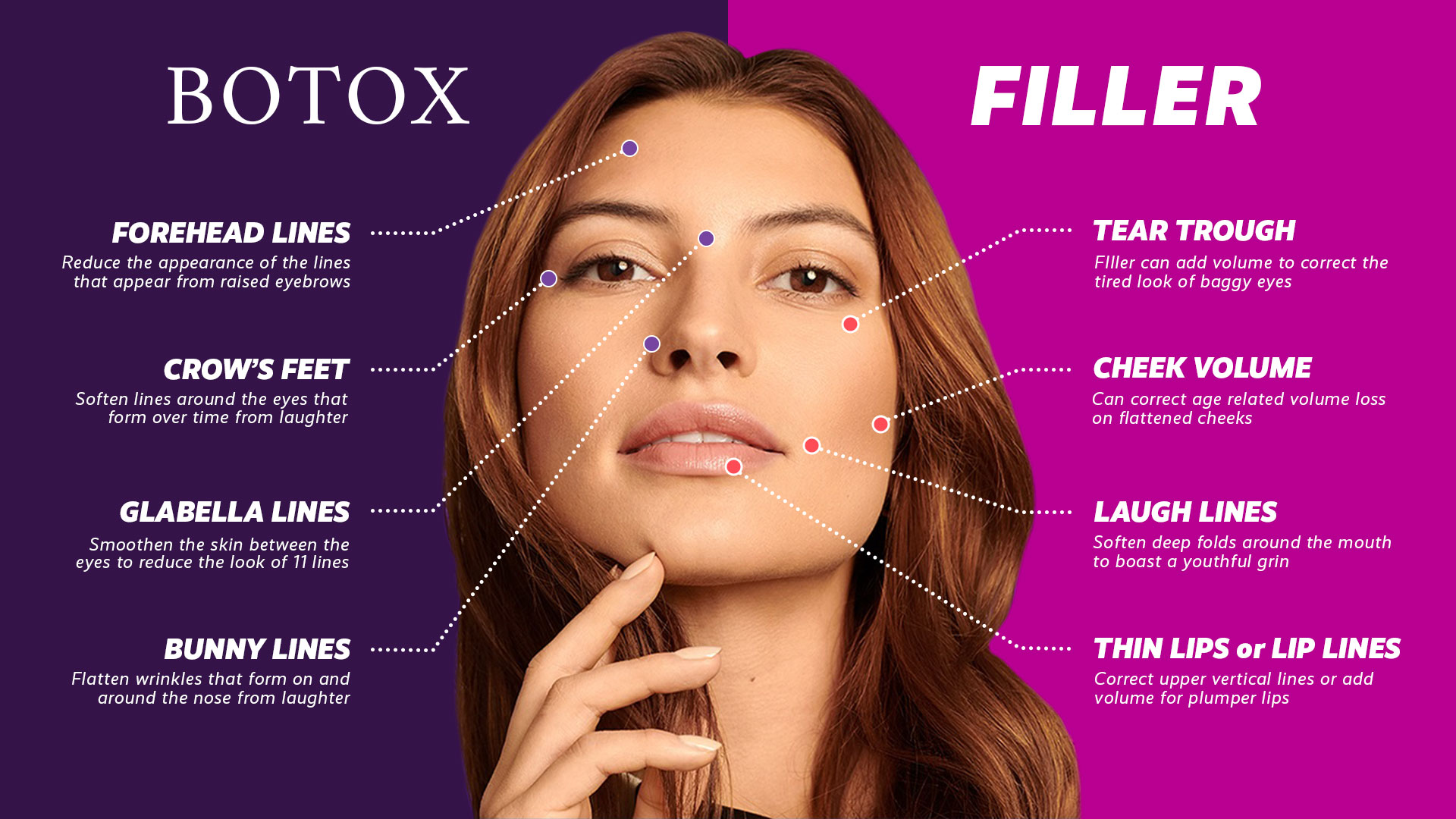 botox vs fillers